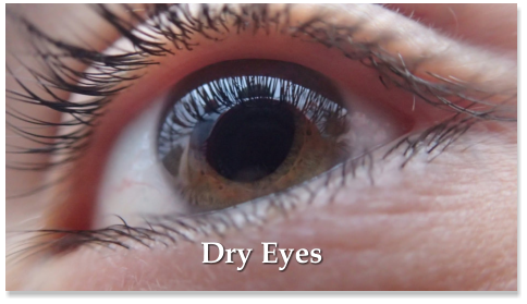 Dry Eyes